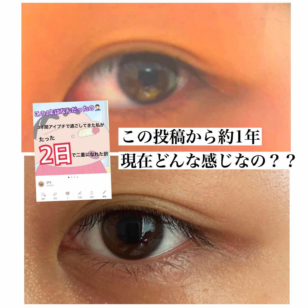 のびーるアイテープ(絆創膏タイプ、レギュラー)/DAISO/二重まぶた用アイテムを使ったクチコミ(1枚目)