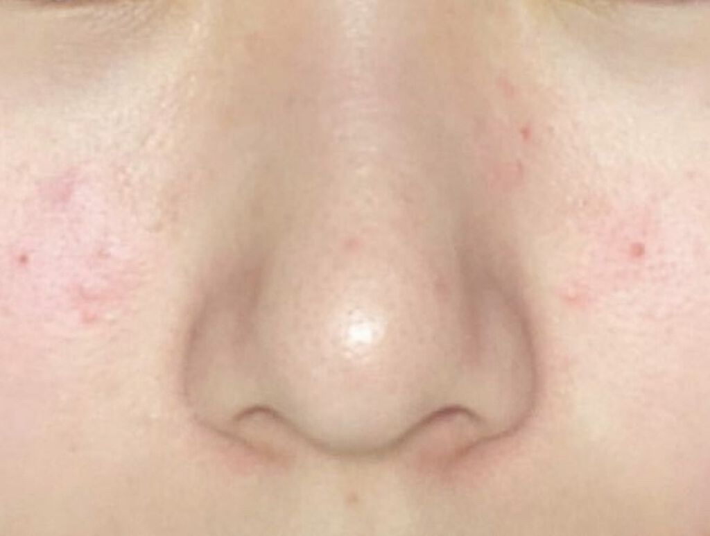 薬用 しみ 集中対策 美容液/メラノCC/美容液を使ったクチコミ（2枚目）