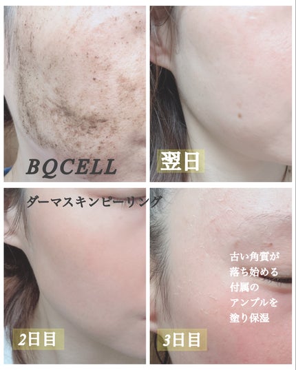 ダーマスキンピーリング/BQCELL/その他キットセットを使ったクチコミ(5枚目)