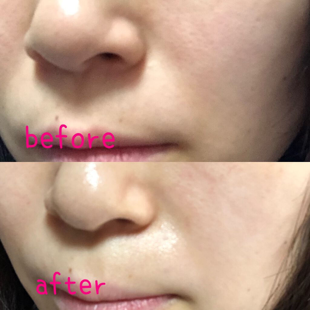 MICRO NEED ヒアルロン酸 セラムパッチ/bijoːu(ビジュー)MICRO NEED/シートマスク・パックを使ったクチコミ(4枚目)