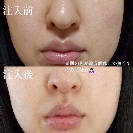 ã¯ãªð«§ on LIPS ããã»ãããç·ãã¢ã«ãã³é
žã¬ããïŒæäžæ¬ã«ã»ãããç·ã«ãã¢ã«ãã³..ãïŒ7æç®ïŒ