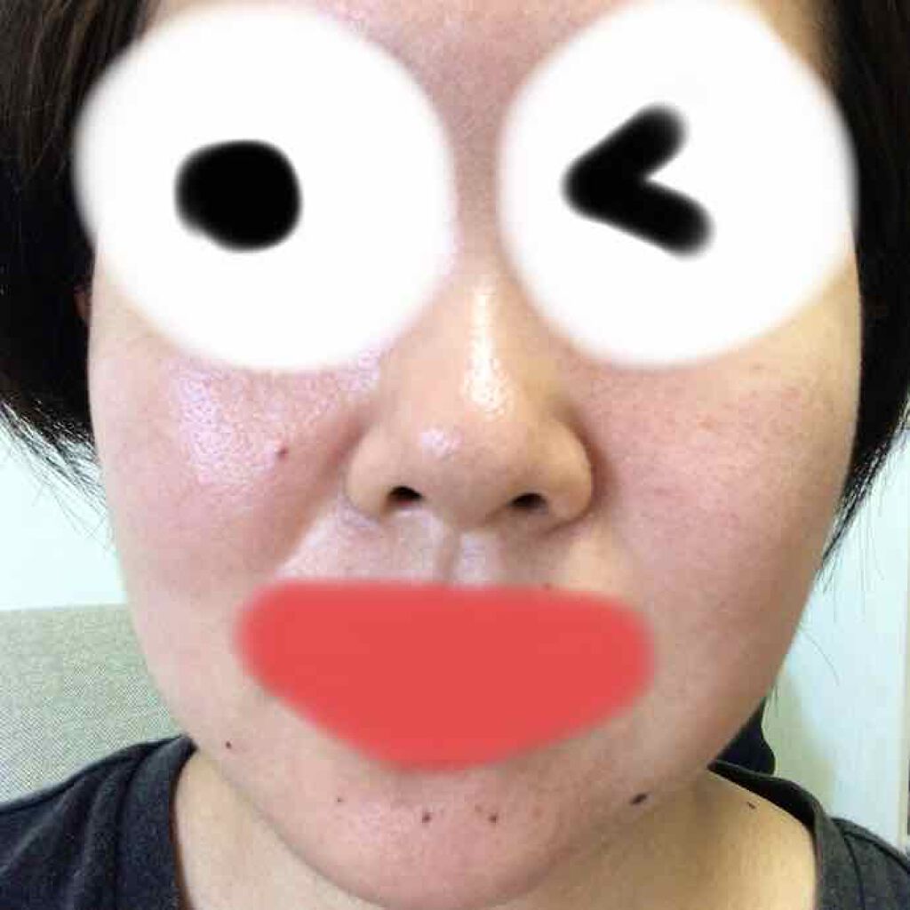 coral♡rouge on LIPS 「ベピオゲル34日目。月曜日に皮膚科に行って新たに2本、もらって..」(3枚目)