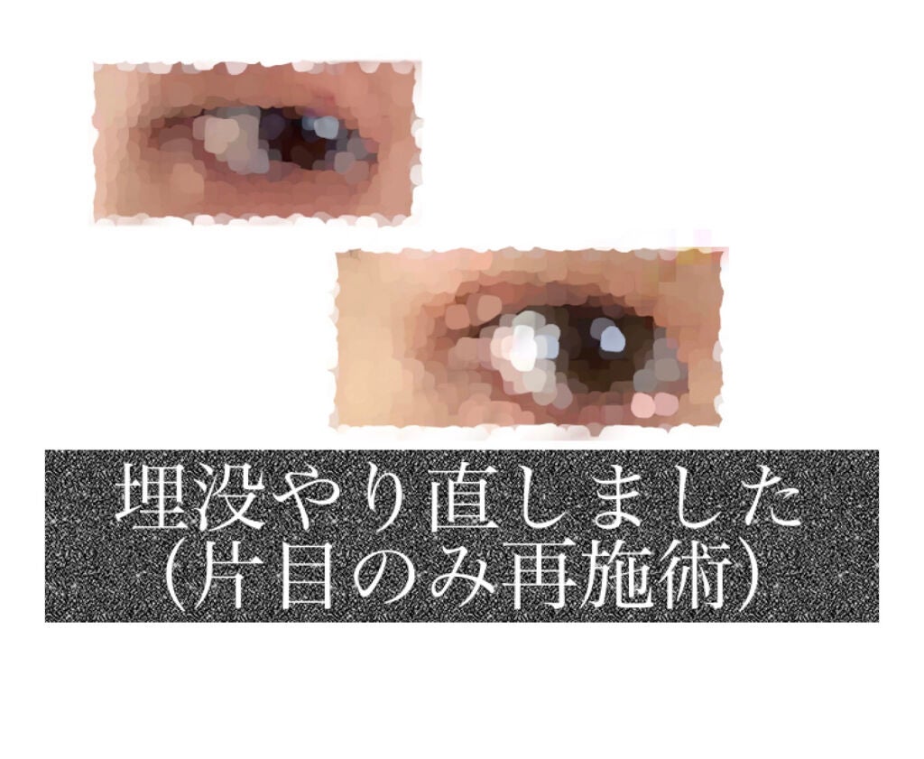 YuMi on LIPS 「埋没の再施術しました。経過まとめです。数ヶ月前に埋没施術しまし..」(1枚目)