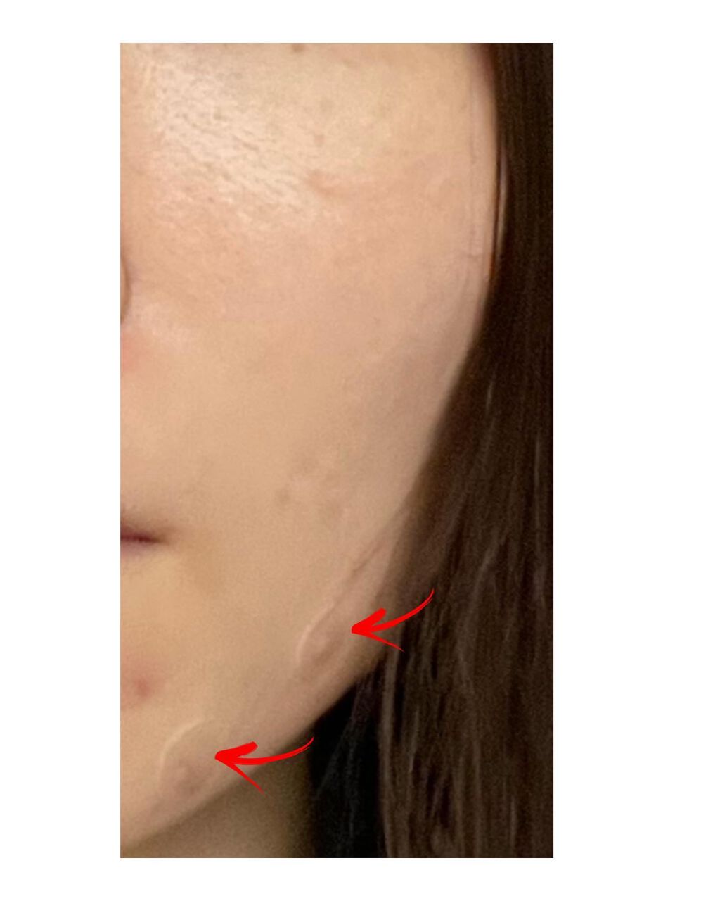 OK CICA CLEAR PATCH/GR/その他を使ったクチコミ(5枚目)