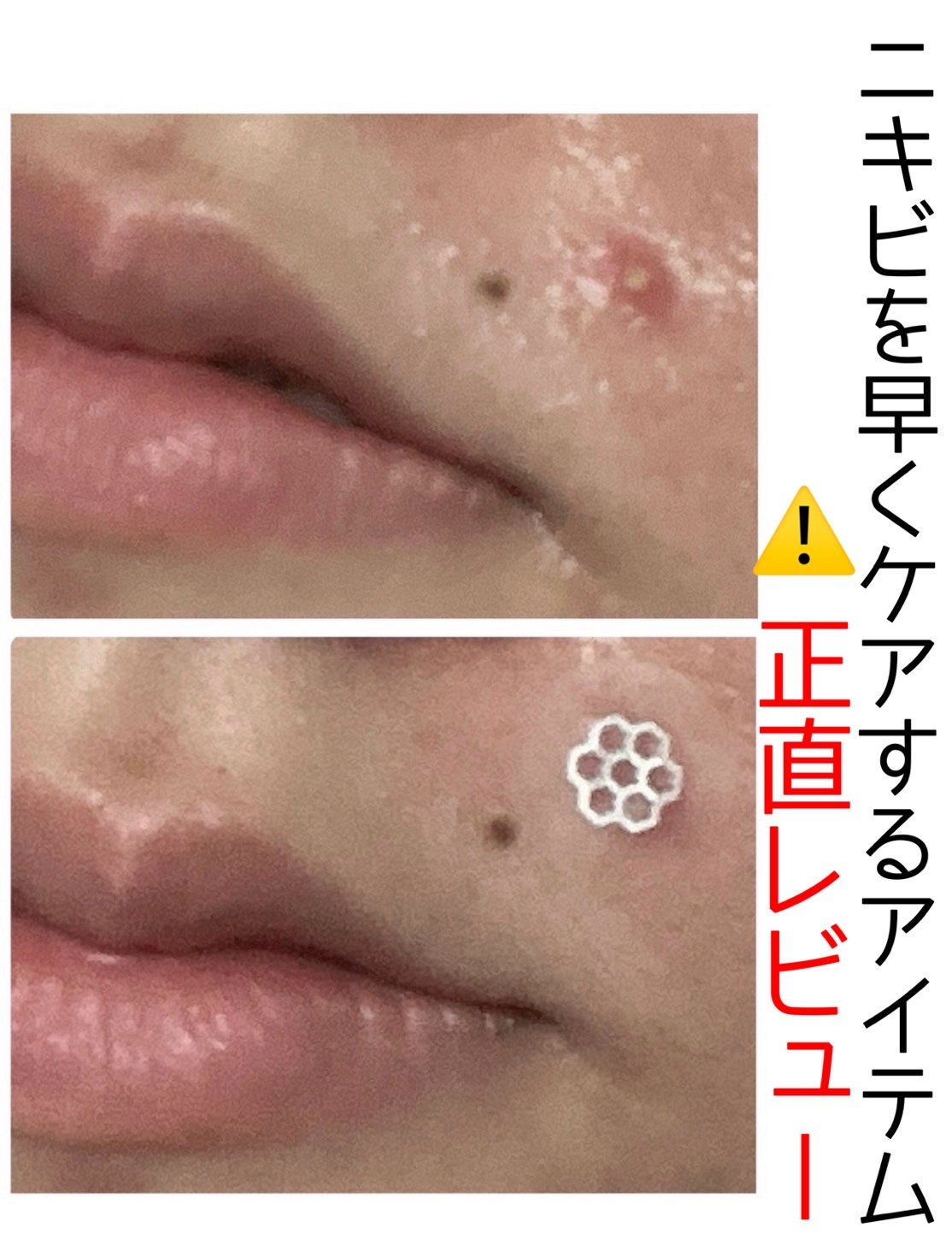 リアルカーミング/イージーダムビューティー/にきびパッチを使ったクチコミ（1枚目）