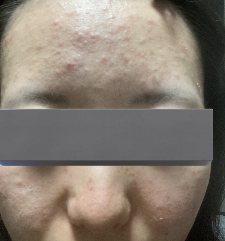 ACアクティブ クレンジングリキッド/NOV/クレンジングウォーターを使ったクチコミ（3枚目）