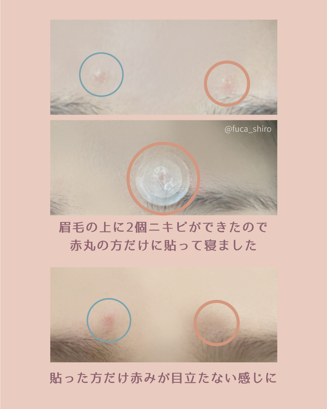 エーキュアショットスポットパッチ/obsero/にきびパッチを使ったクチコミ（3枚目）