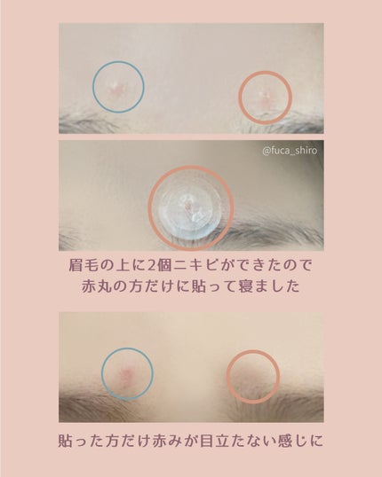 エーキュアショットスポットパッチ/obsero/にきびパッチを使ったクチコミ(3枚目)