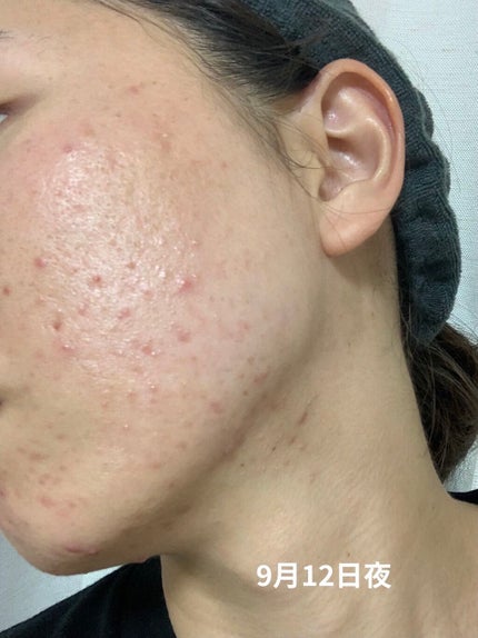 薬用 しみ 集中対策 美容液/メラノCC/美容液を使ったクチコミ(7枚目)