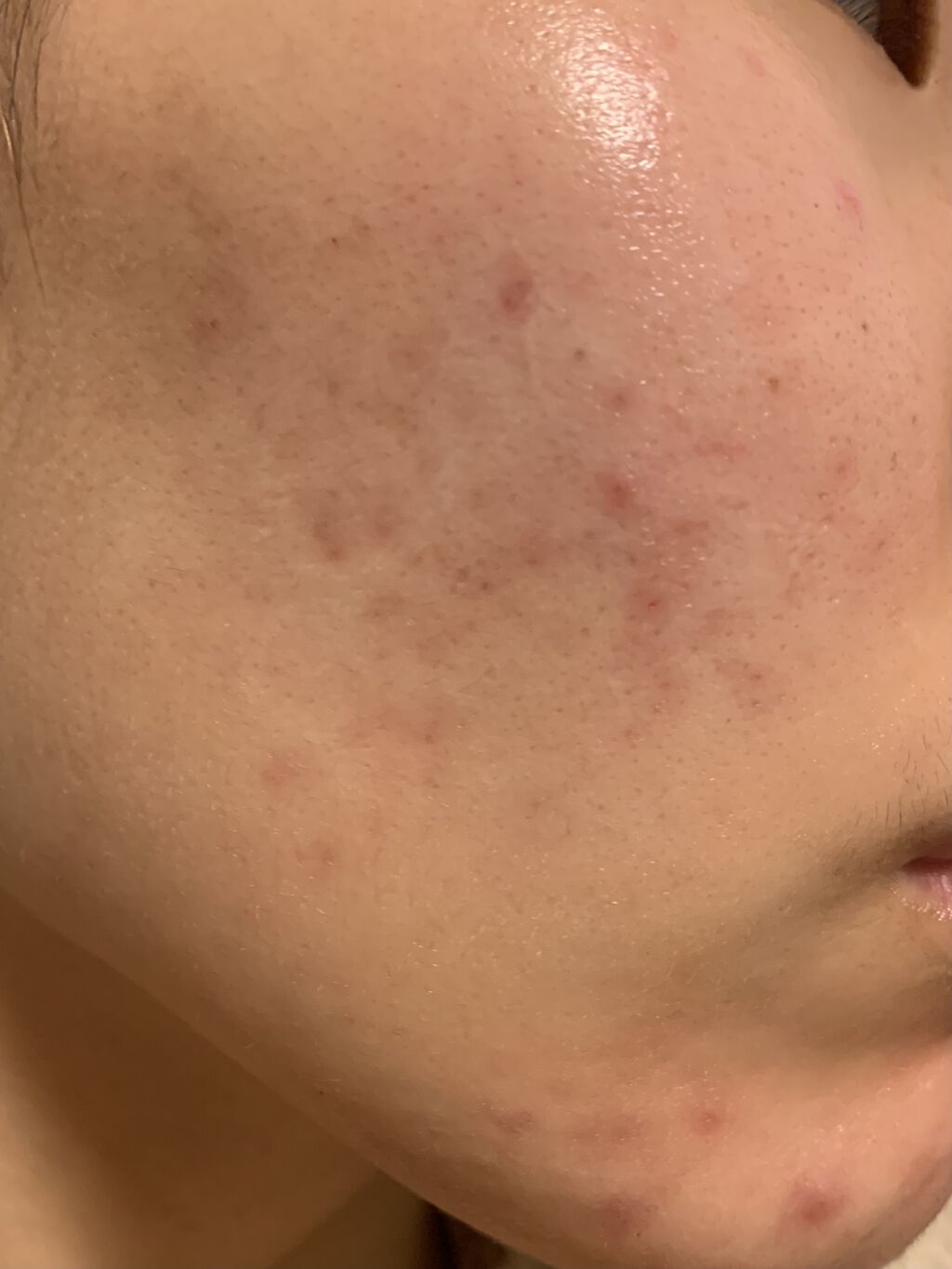 ベピオゲル/マルホ株式会社/その他を使ったクチコミ（2枚目）