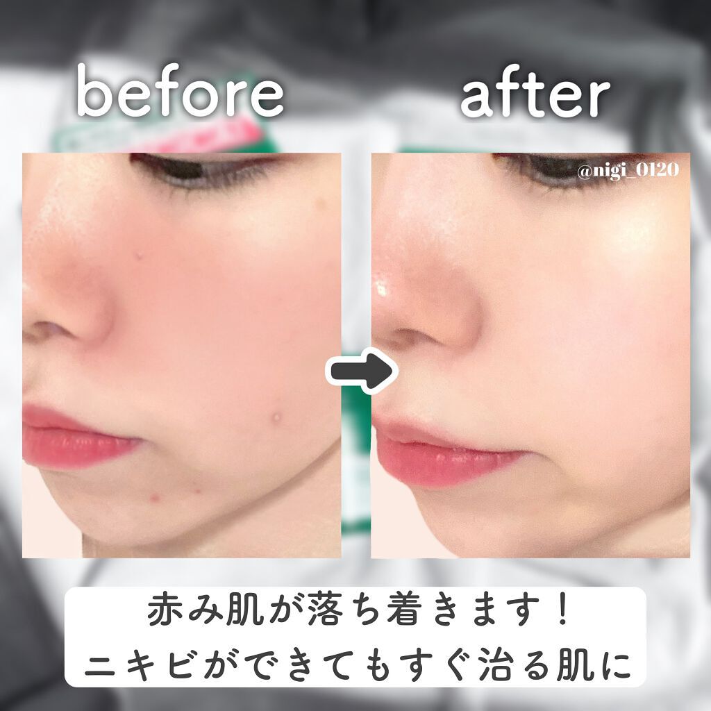 プロCICA クリアスポットパッチ/VT/その他スキンケアを使ったクチコミ(7枚目)