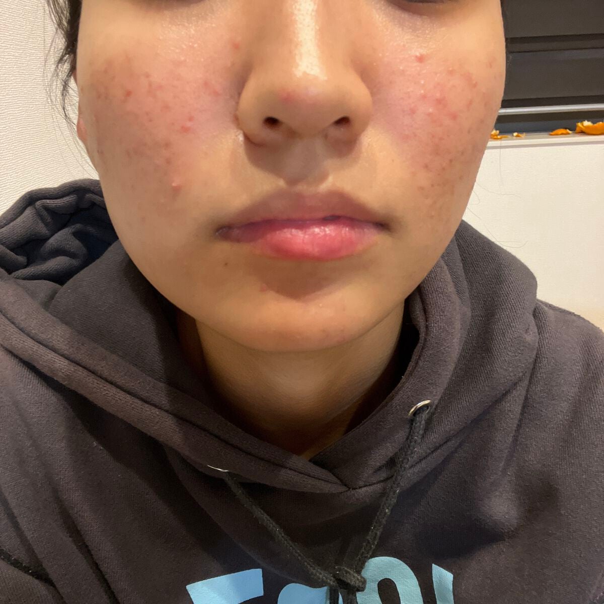 ぽん on LIPS 「なんでこんなあれるのーちょっと治ったと思いきやまた荒れ始めまし..」(1枚目)