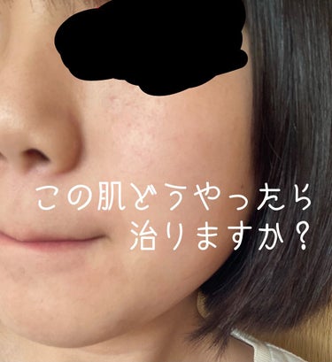 supreme_cosme_z22et on LIPS 「【この肌治る方法ありませんか？？⠀】私すごい凸凹肌で、治る方法..」（1枚目）