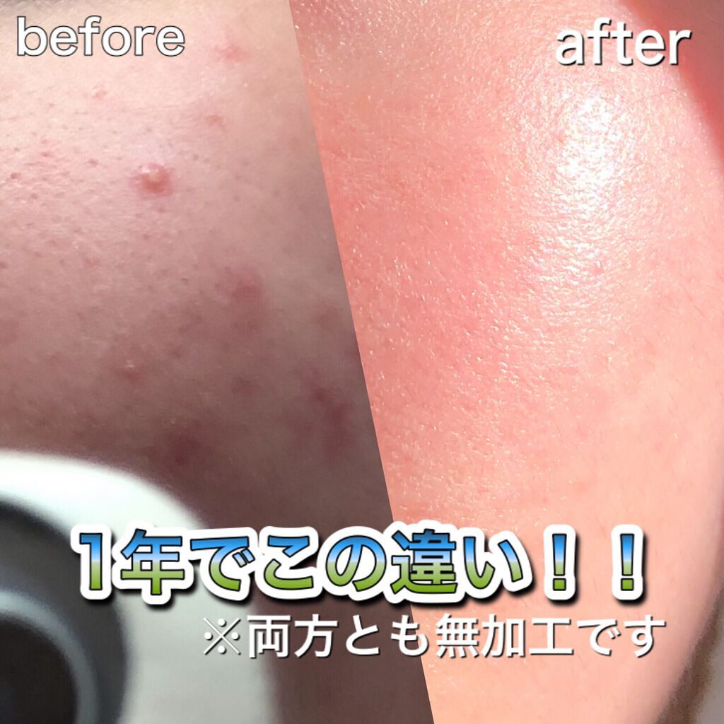 ティーツリーケア ソリューション エッセンシャルマスクEX/MEDIHEAL/シートマスク・パックを使ったクチコミ(1枚目)