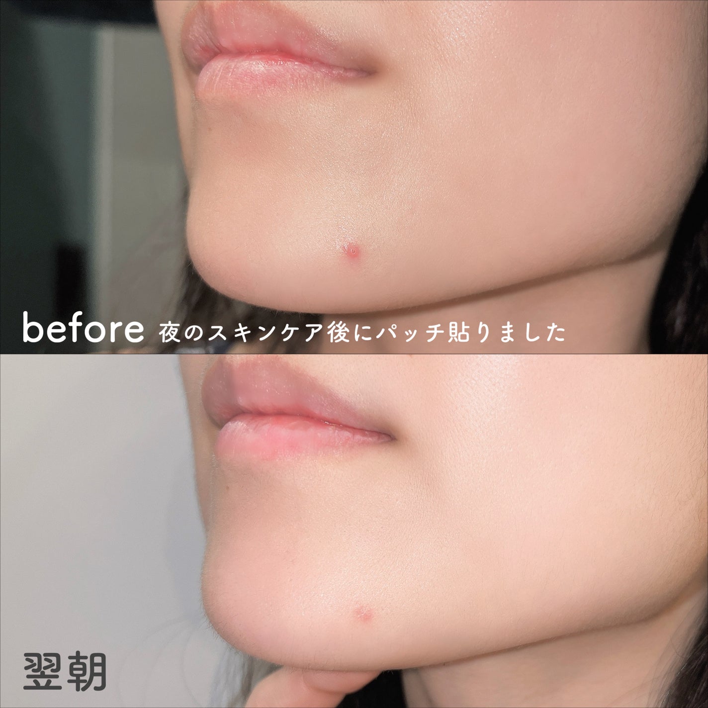 ビューティーミラクルパッチスポットカバー/Rael/にきびパッチを使ったクチコミ(7枚目)