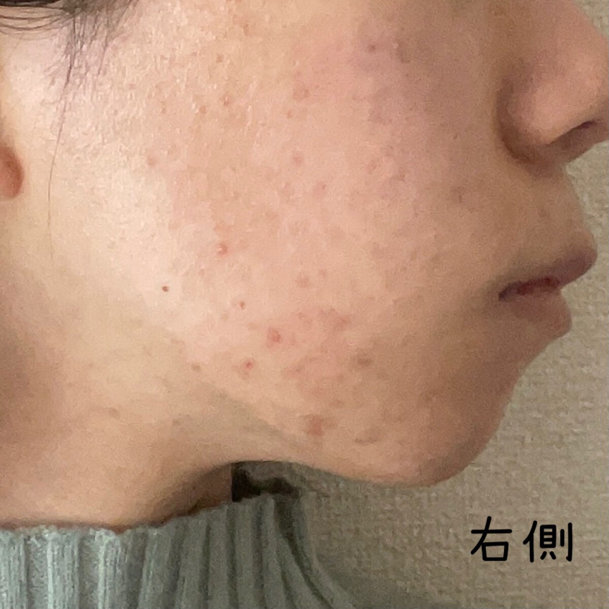 ブライトニングピーリングジェル/Dr.G/ピーリングを使ったクチコミ（3枚目）