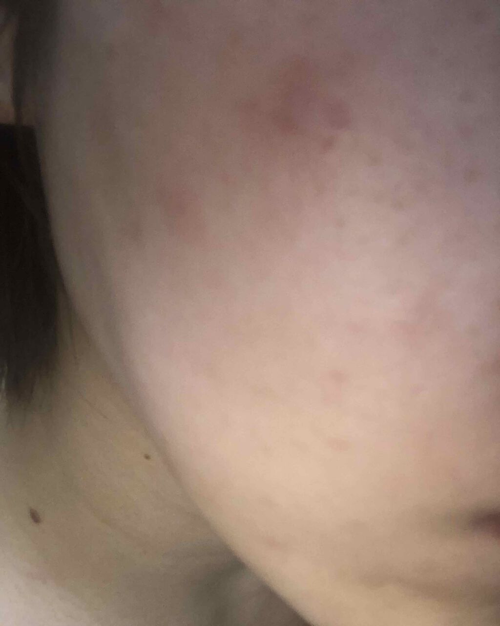 エピデュオゲル/マルホ株式会社/その他を使ったクチコミ（1枚目）