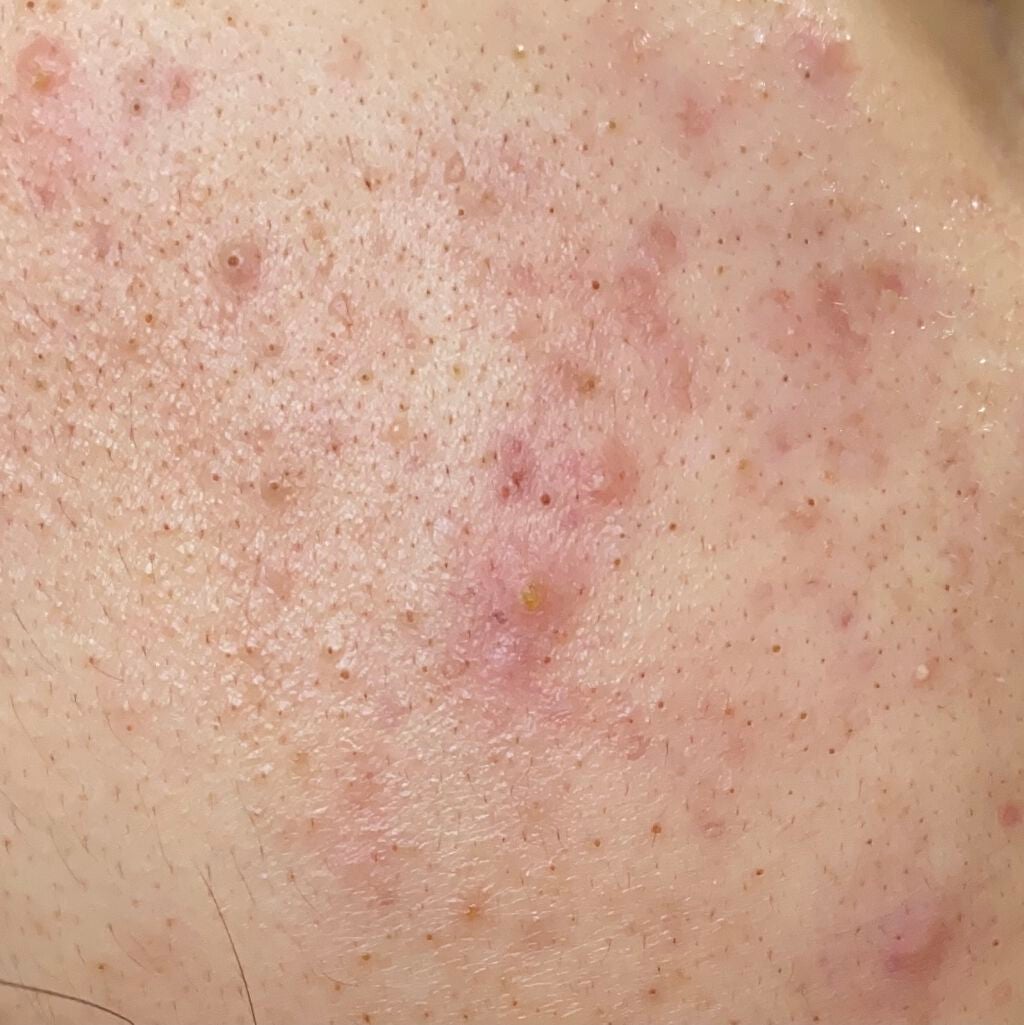 らんらん on LIPS 「ニキビケアは頑張ってるものの最近毛穴が目立つように感じます(;..」(2枚目)