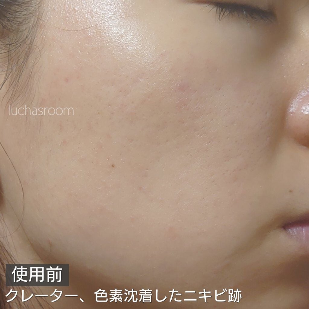 トリア・スキン エイジングケアレーザー/トリア/美顔器・マッサージを使ったクチコミ(2枚目)