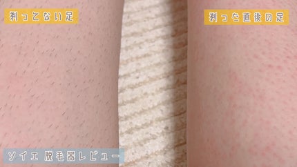 脱毛器 ソイエ ES-WS35 /Panasonic/家庭用脱毛器を使ったクチコミ(4枚目)