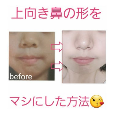 もも on LIPS 「【鼻で悩んでいる方は是非見ていただきたいです。】個人差はあるか..」（1枚目）