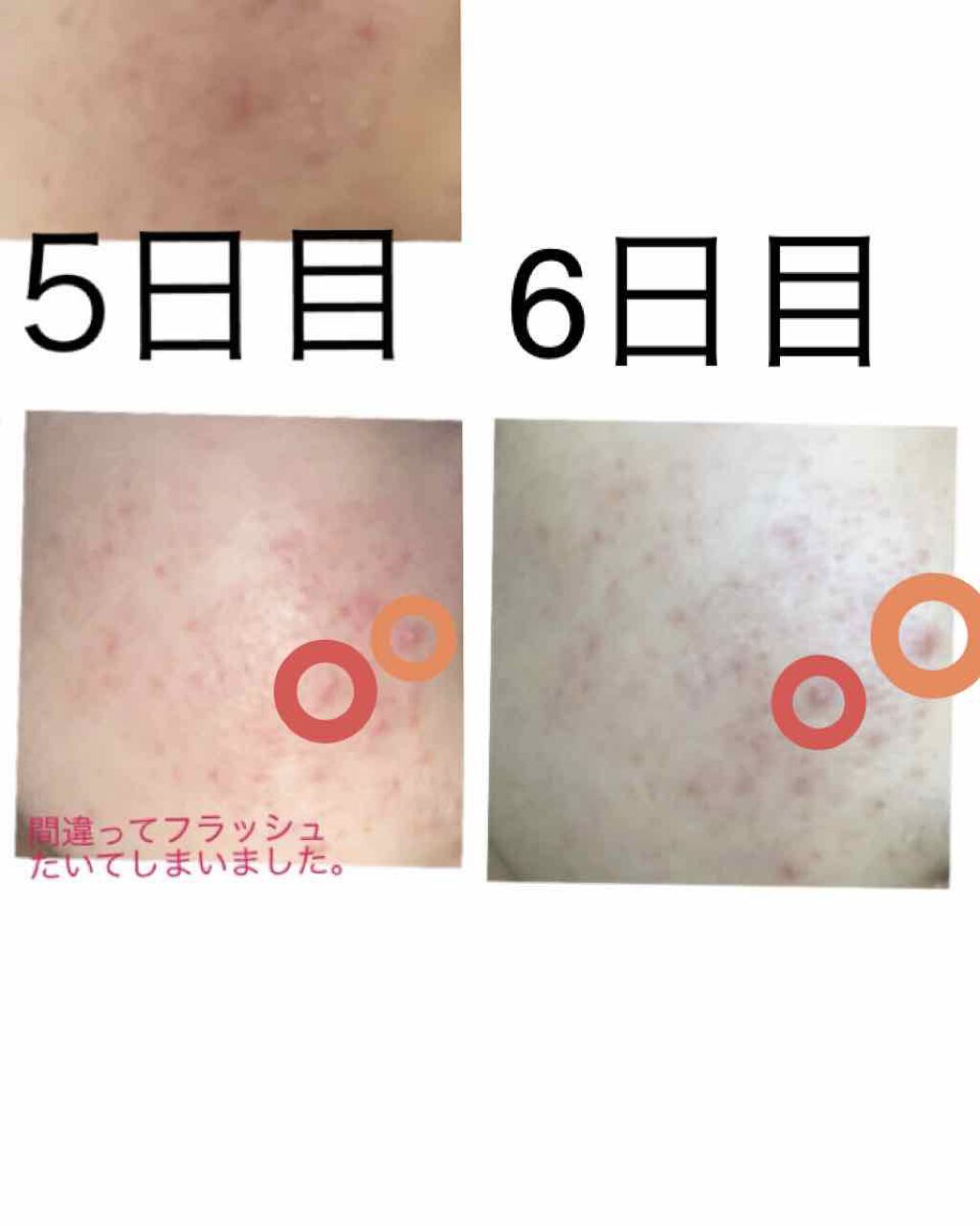 ペアアクネクリームW(医薬品)/ペア/その他を使ったクチコミ（2枚目）