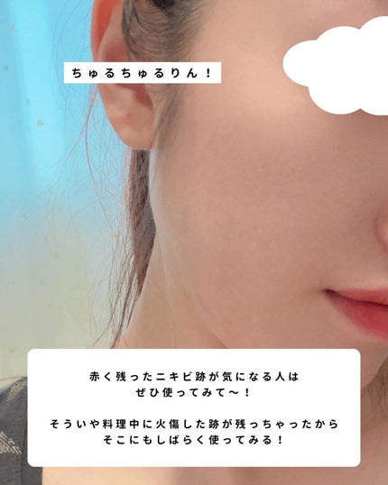 ニキビあとケアジェル/アットノン/その他スキンケアを使ったクチコミ(6枚目)