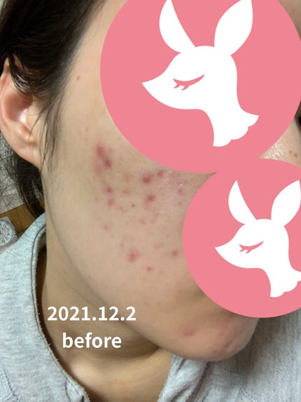 Noni Ampule/celimax/美容液を使ったクチコミ(5枚目)