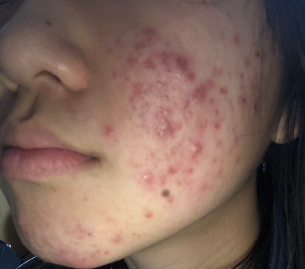 ❤︎𝐑𝐄𝐈𝐊𝐀❤︎ on LIPS 「以前の投稿を久しぶりに見返してみたところ、治るどころかもっと酷..」(1枚目)