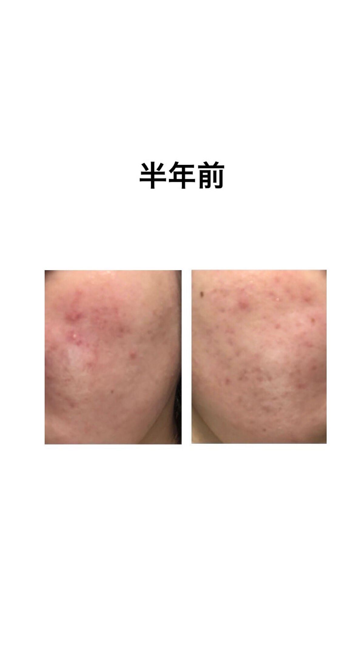 モイスチュアマイルドホワイト パーフェクトエッセンス/モイスチュアマイルド ホワイト/オールインワン化粧品を使ったクチコミ(2枚目)