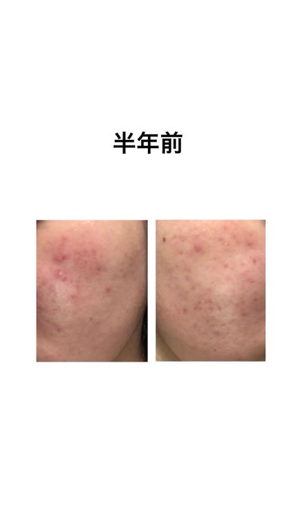 モイスチュアマイルドホワイト パーフェクトエッセンス/モイスチュアマイルド ホワイト/オールインワン化粧品を使ったクチコミ(2枚目)