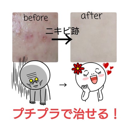 薬用 しみ 集中対策 美容液/メラノCC/美容液を使ったクチコミ(1枚目)