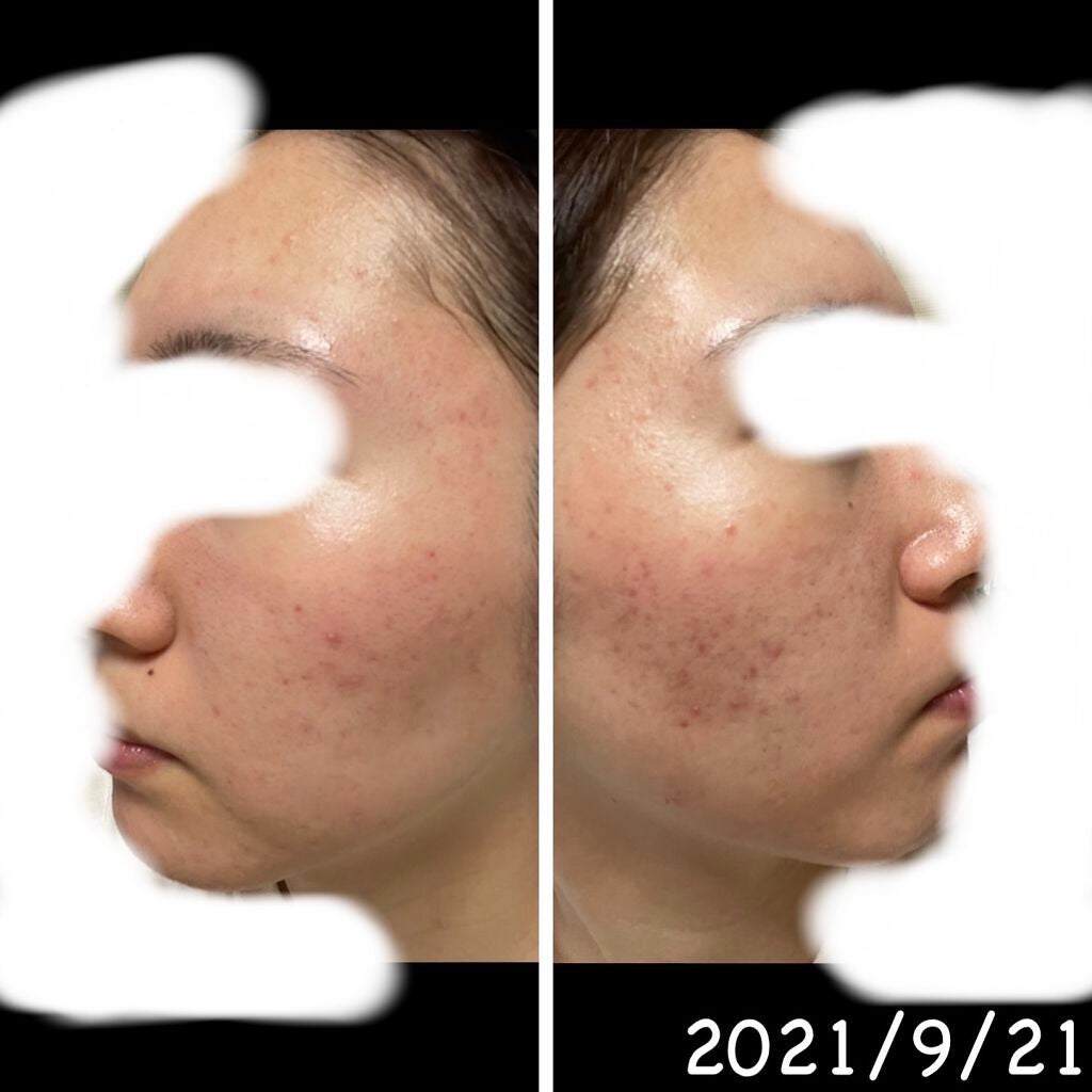 Honk❁ on LIPS 「20歳前半の女がニキビに悩まされすぎてダーマペン受けてみた。こ..」(2枚目)