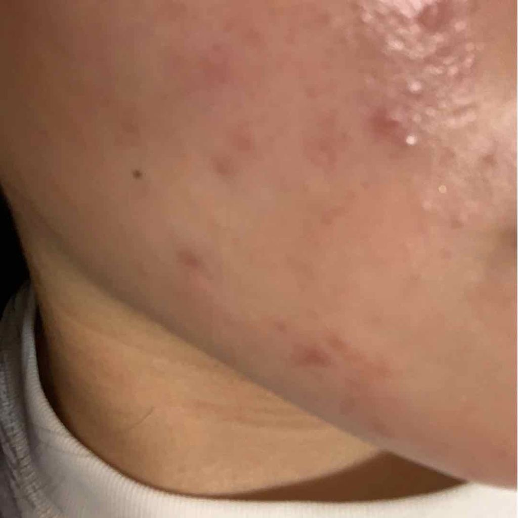 エピデュオゲル/マルホ株式会社/その他を使ったクチコミ（1枚目）