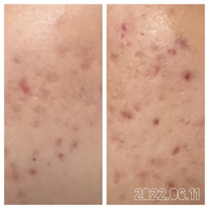 ニキビあとケアジェル/アットノン/その他スキンケアを使ったクチコミ(4枚目)