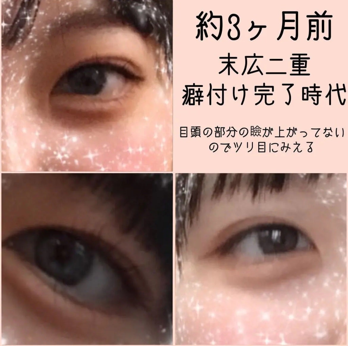 アイテープ(絆創膏タイプ、レギュラー、70枚)/DAISO/二重まぶた用アイテムを使ったクチコミ(3枚目)