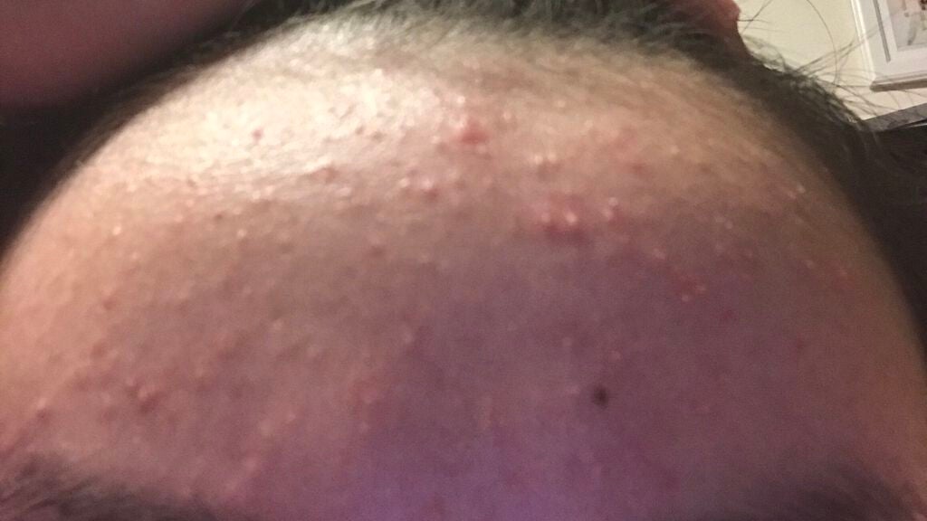 りこ on LIPS 「ニキビ頑張って治そー!計画っ!今日から頑張ってニキビを治します..」(1枚目)