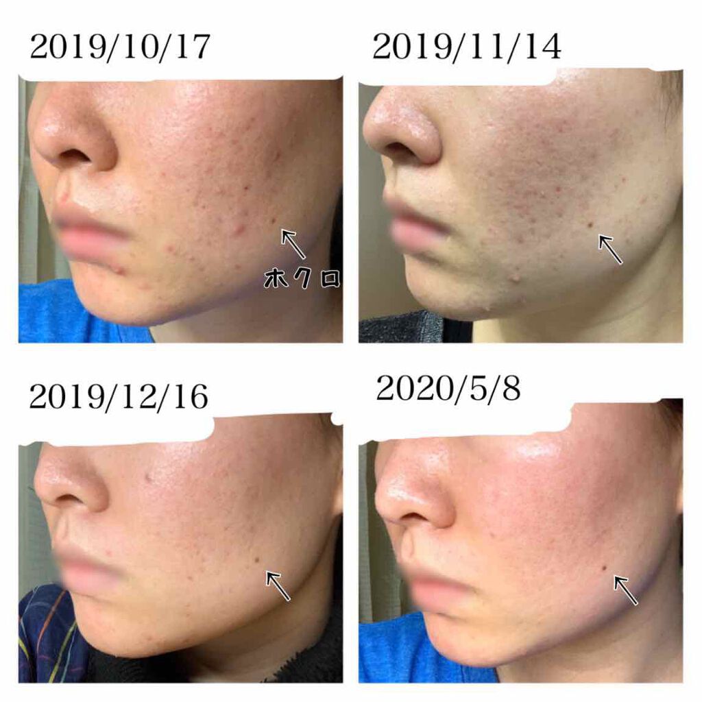 コールドクリーム/ウテナモイスチャー/クレンジングクリームを使ったクチコミ（2枚目）