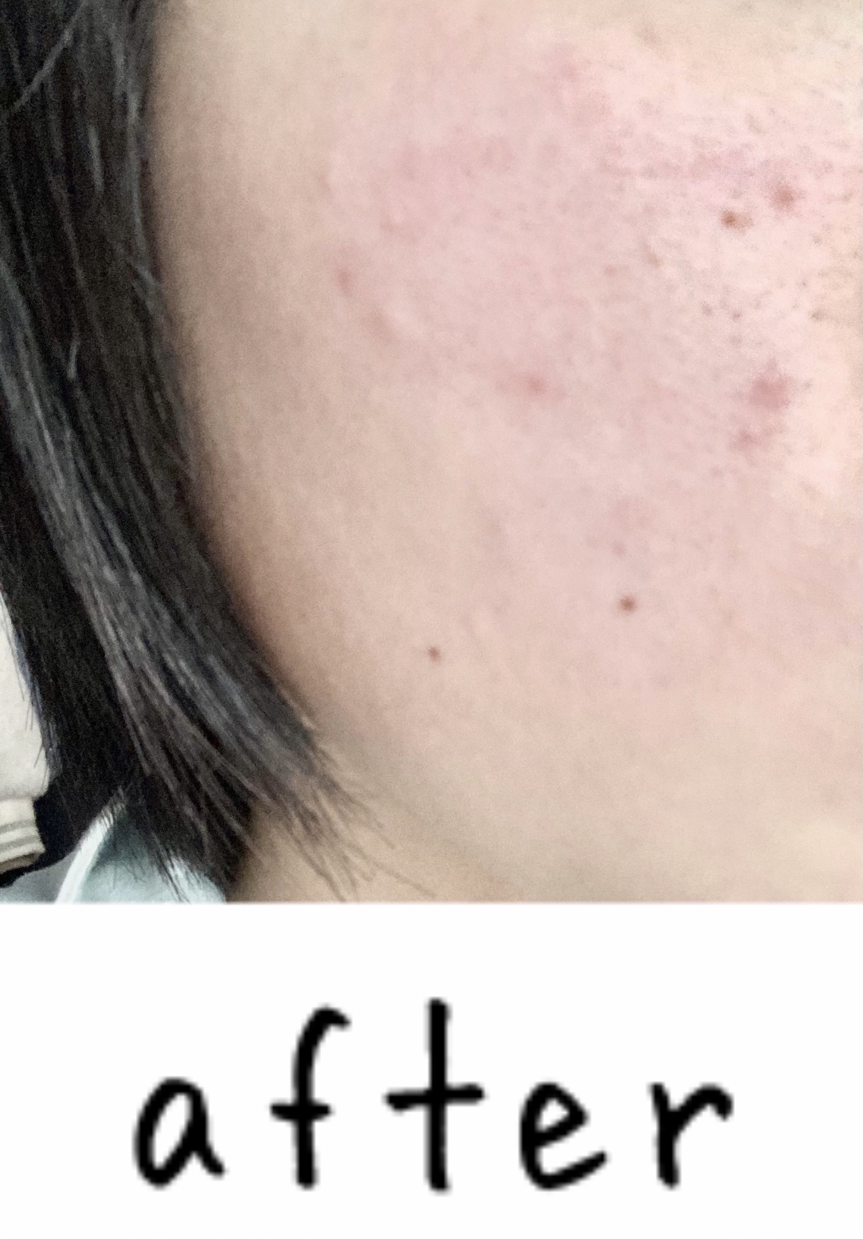 ダーマレーザースーパーVC100マスク/クオリティファースト/シートマスク・パックを使ったクチコミ（3枚目）