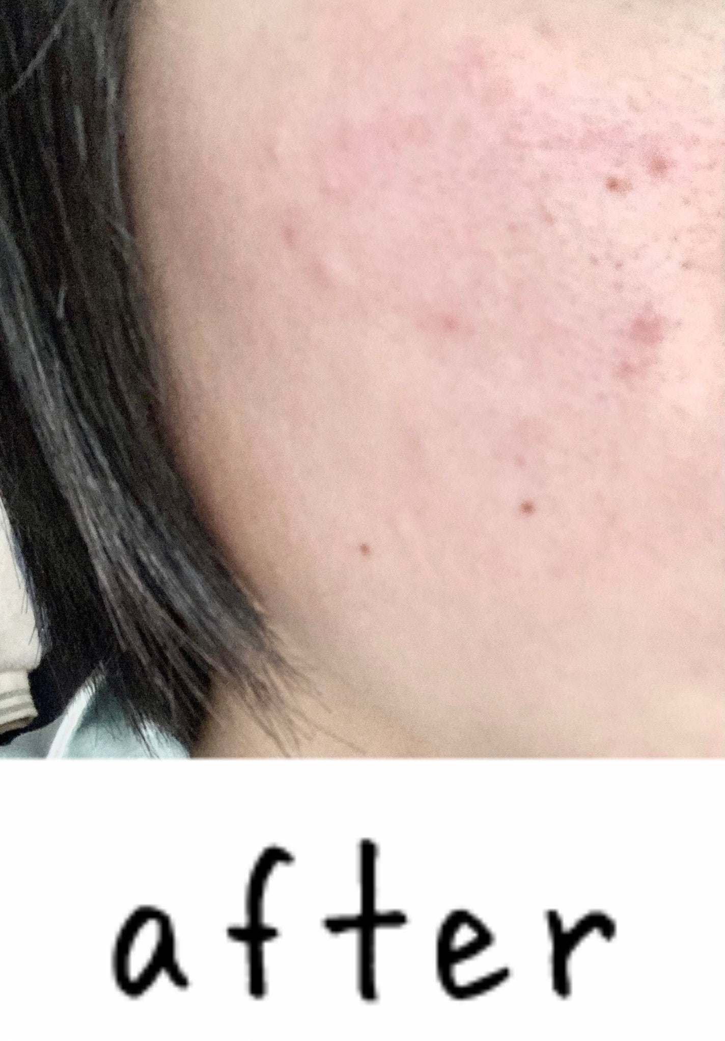 ダーマレーザースーパーVC100マスク/クオリティファースト/シートマスク・パックを使ったクチコミ(3枚目)