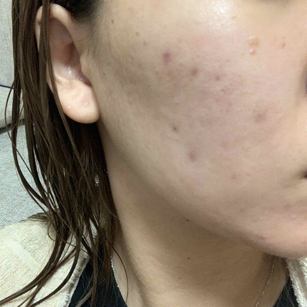 薬用 しみ 集中対策 美容液/メラノCC/美容液を使ったクチコミ(1枚目)