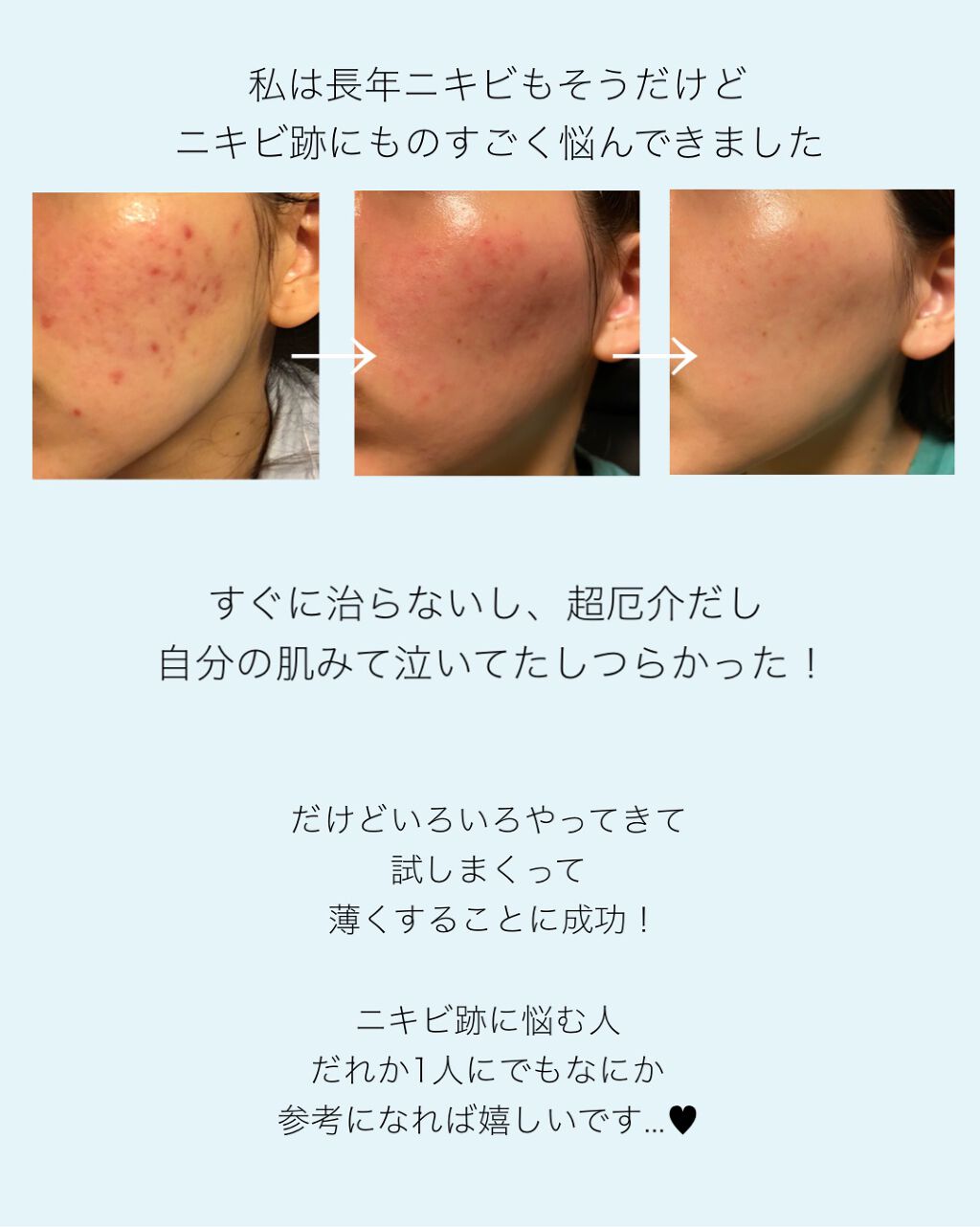 VC-20 ビタミンC誘導体/TUNEMAKERS/美容液を使ったクチコミ(2枚目)