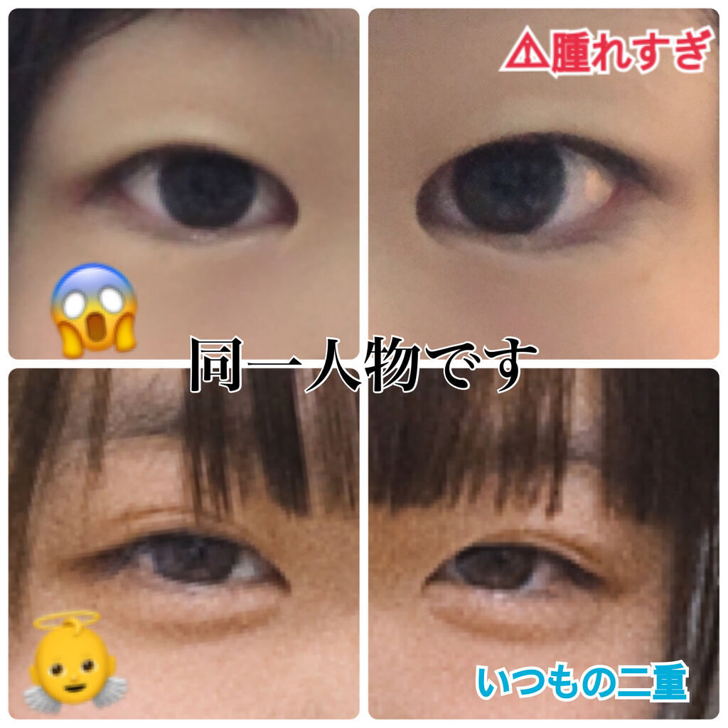 ニベアクリーム ニベアを使った口コミ みなさん 目が腫れたときどう対処してます By ゆーカ 脂性肌 10代後半 Lips