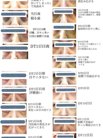 Saya on LIPS 「念願のクマ取りの施術をしました。記録に残すためと、今後施術を希..」(6枚目)
