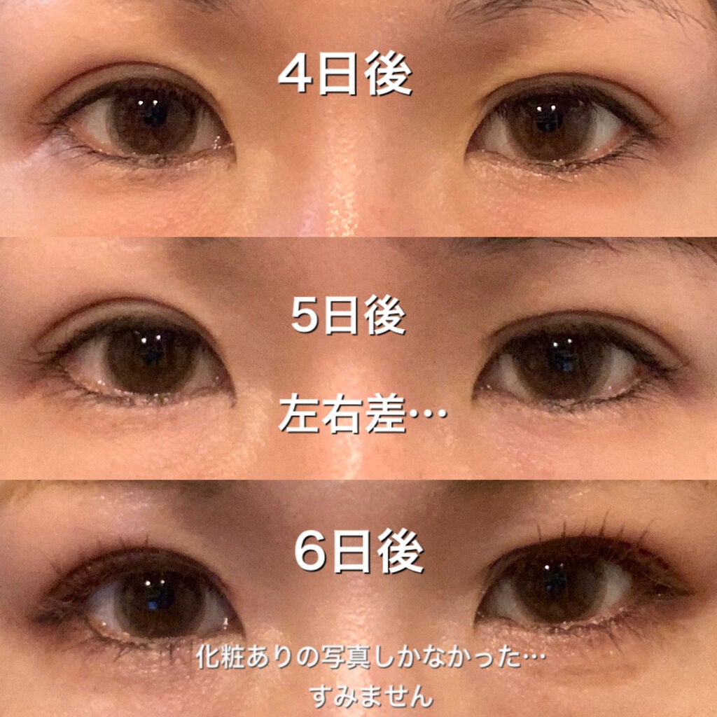 yu___n@フォロバします🌸 on LIPS 「二重埋没して3週間経ちました!1週間までのレポは別投稿にあるの..」(4枚目)