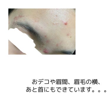 メラノCC 薬用しみ対策 美白化粧水のクチコミ「頬やおデコ、眉間、眉毛周辺、鼻、顎、首などにできるニキビにとても悩んでいます💦
皮膚科に行って.....」（2枚目）