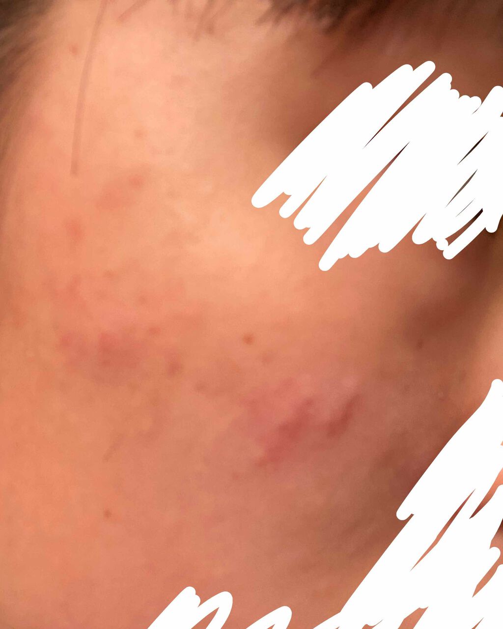 ぽんず on LIPS 「ほんとに汚くてごめんなさい🙇♀️ニキビ跡がひどいなんとかした..」(3枚目)