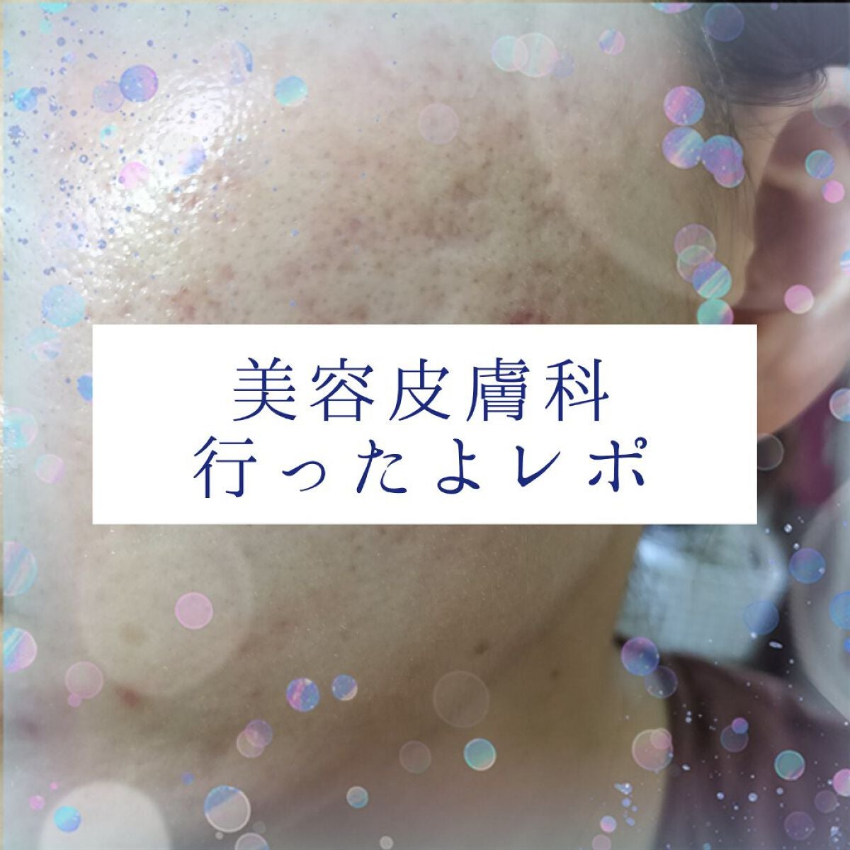 miina@汚肌工事録⚠️ on LIPS 「9/14皮膚科併設の#美容皮膚科で#ICON(フォトフェイシャ..」(1枚目)