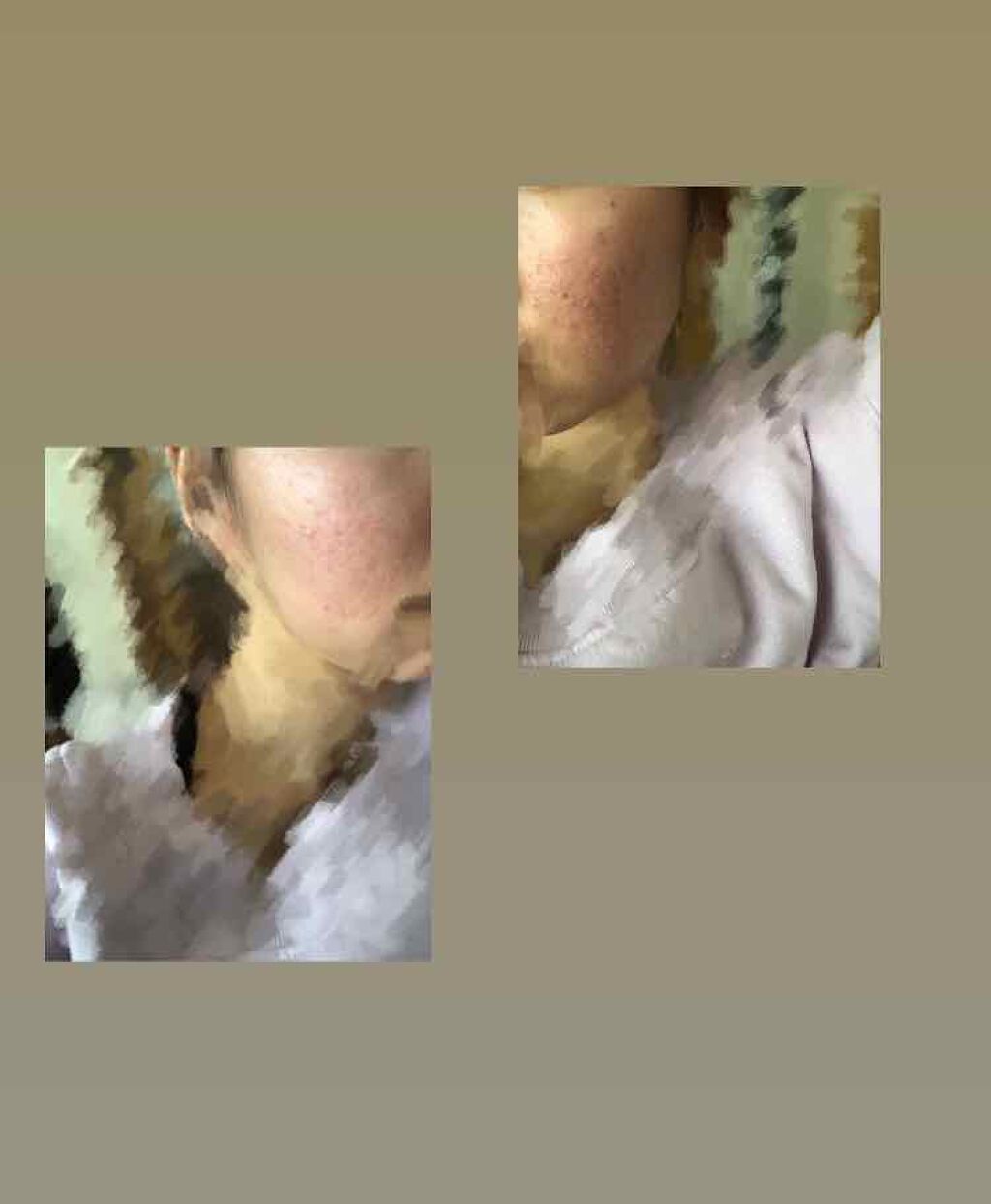 ゼビアックス(医薬品)/マルホ株式会社/その他を使ったクチコミ（2枚目）