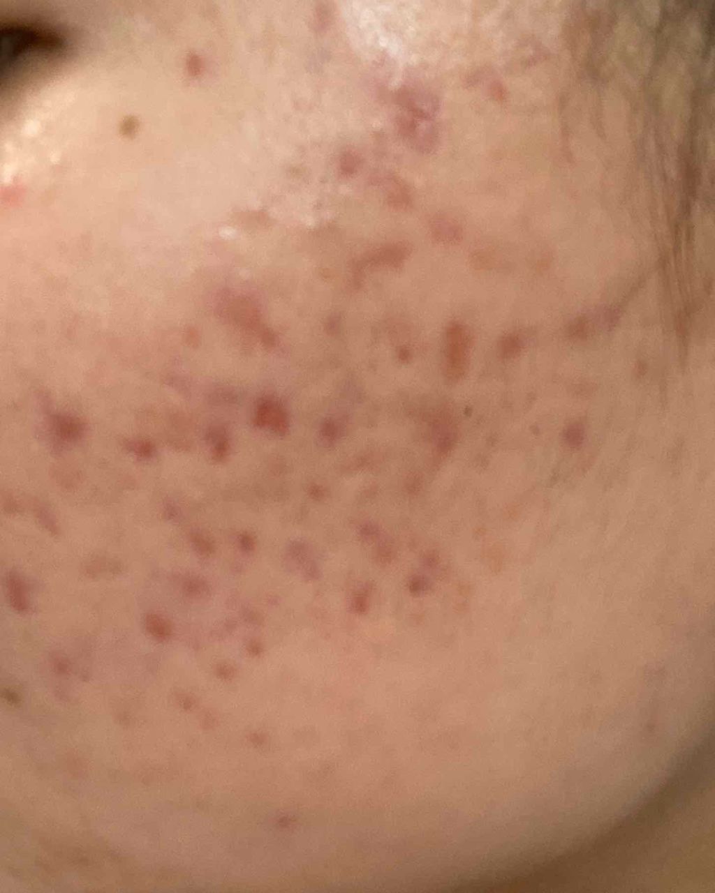 さあゆ on LIPS 「自己満メモ書き小5からニキビに悩んできて今が最高にニキビ肌です..」(2枚目)